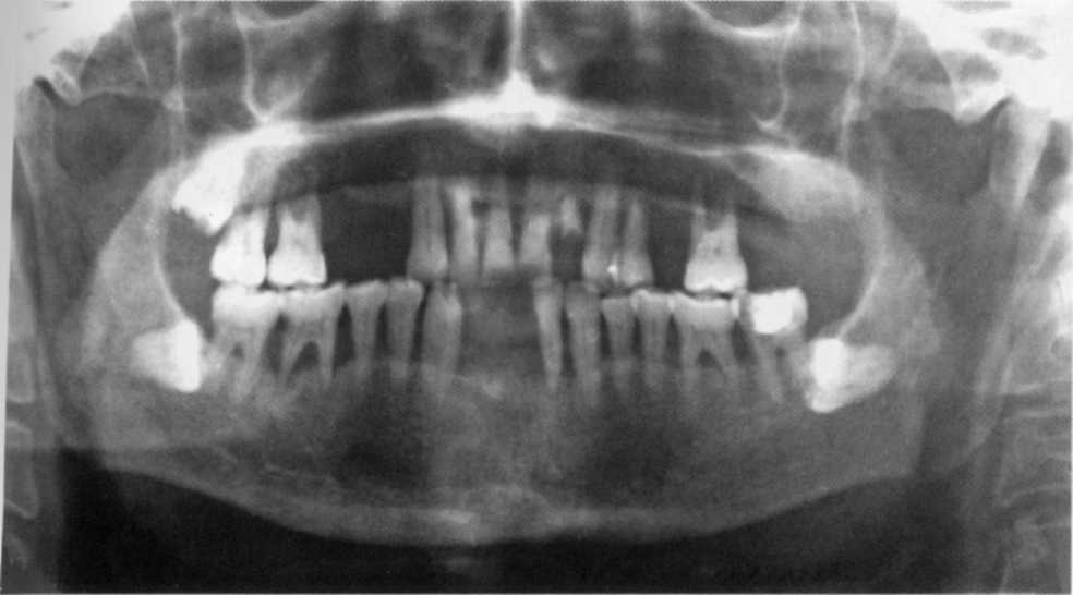 Рентгенологическая картина костной ткани челюстей при пародонтите тяжелой степени