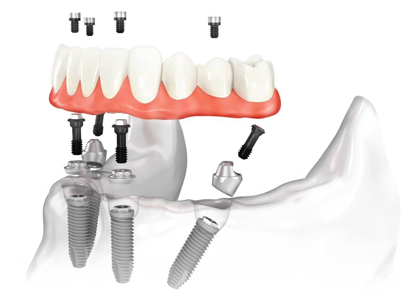 Особенности несъемных протезов. Имплантация зубов all on 4. Имплант Нобель all on 4. Имплантация зубов по технологии «all on 4». Импланты зубные Nobel all-on-4.