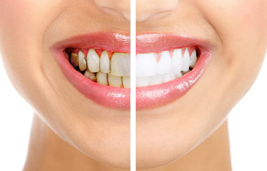 Ретенция зубов - Разновидности | Устранение аномалии