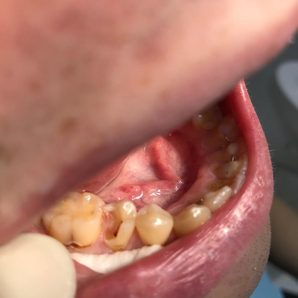 Восстановление зуба - Нехирургические способы