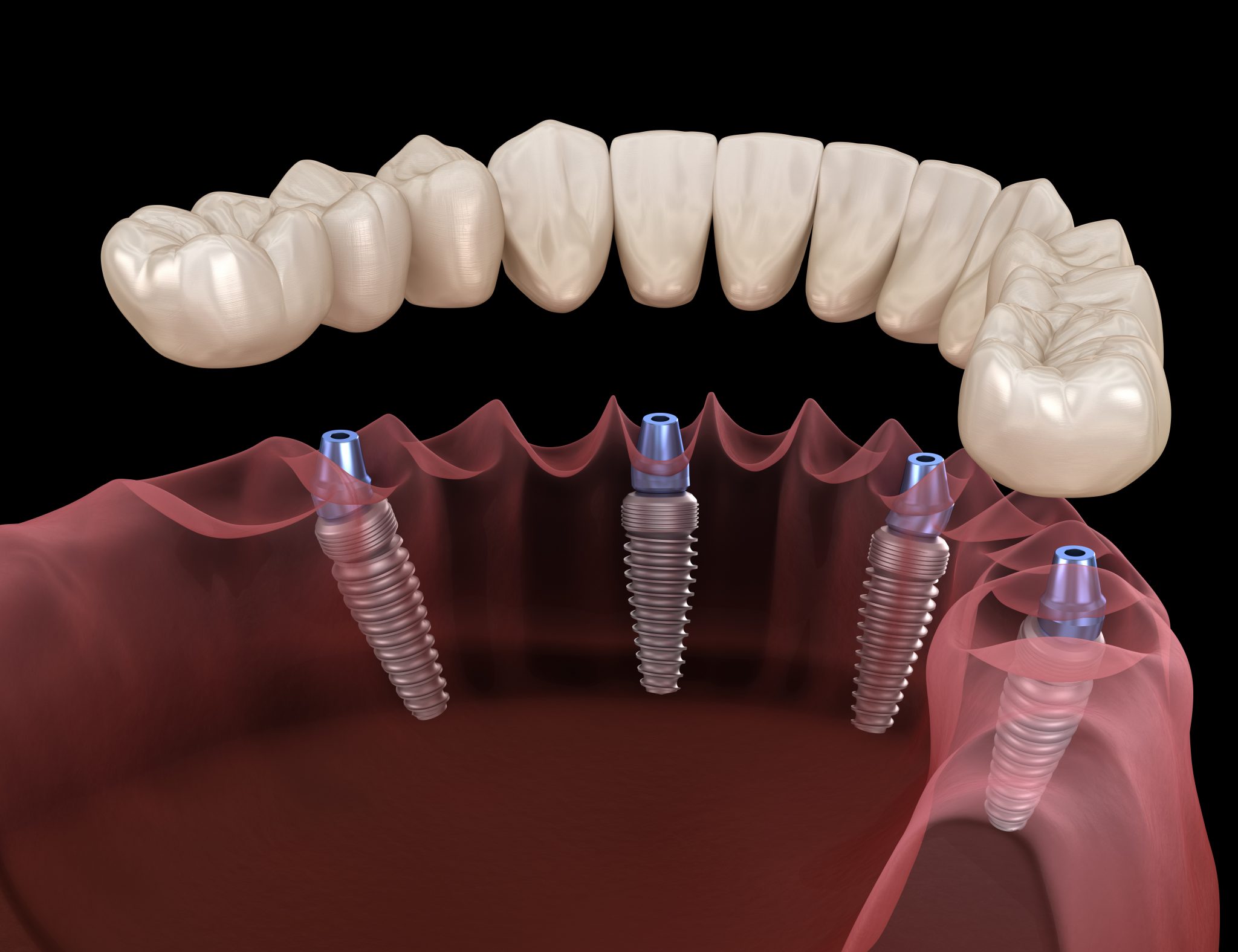 Имплантация нескольких зубов подряд