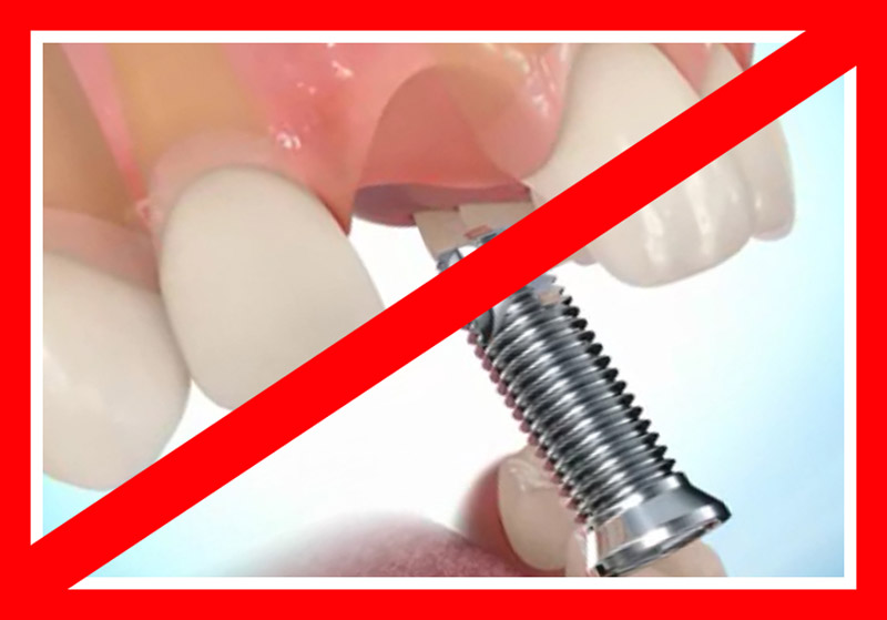 Кому нельзя проводить имплантацию зубов
