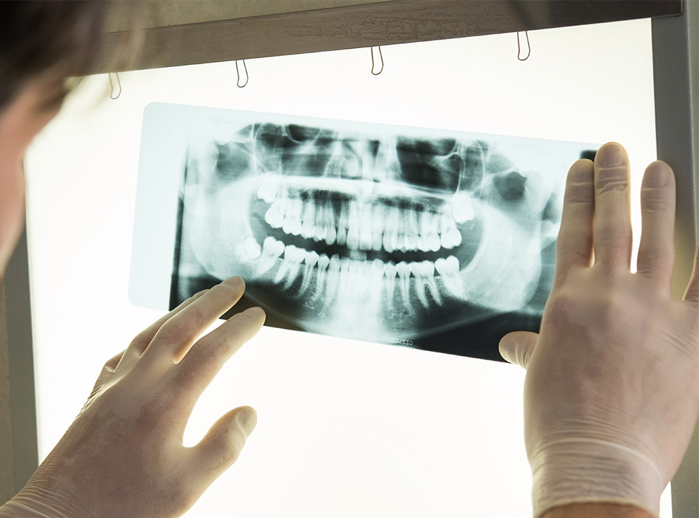 Возможно ли лечение зубов без рентгена?