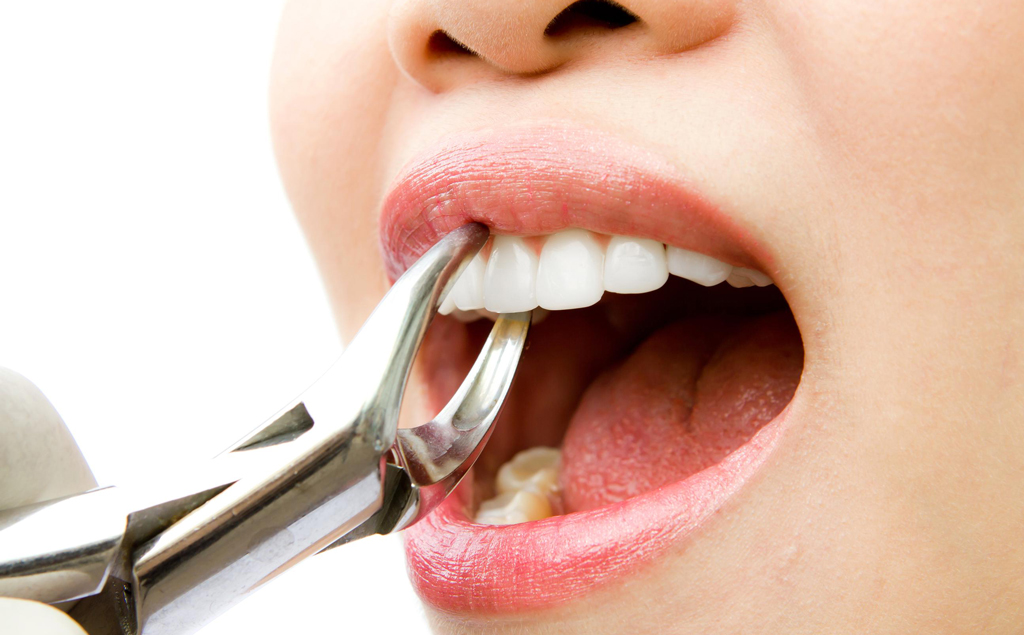 Делать операцию по удалению зуба или нет
