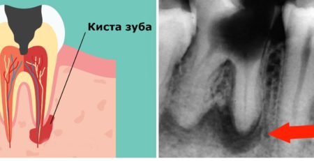 Опасна ли киста зуба