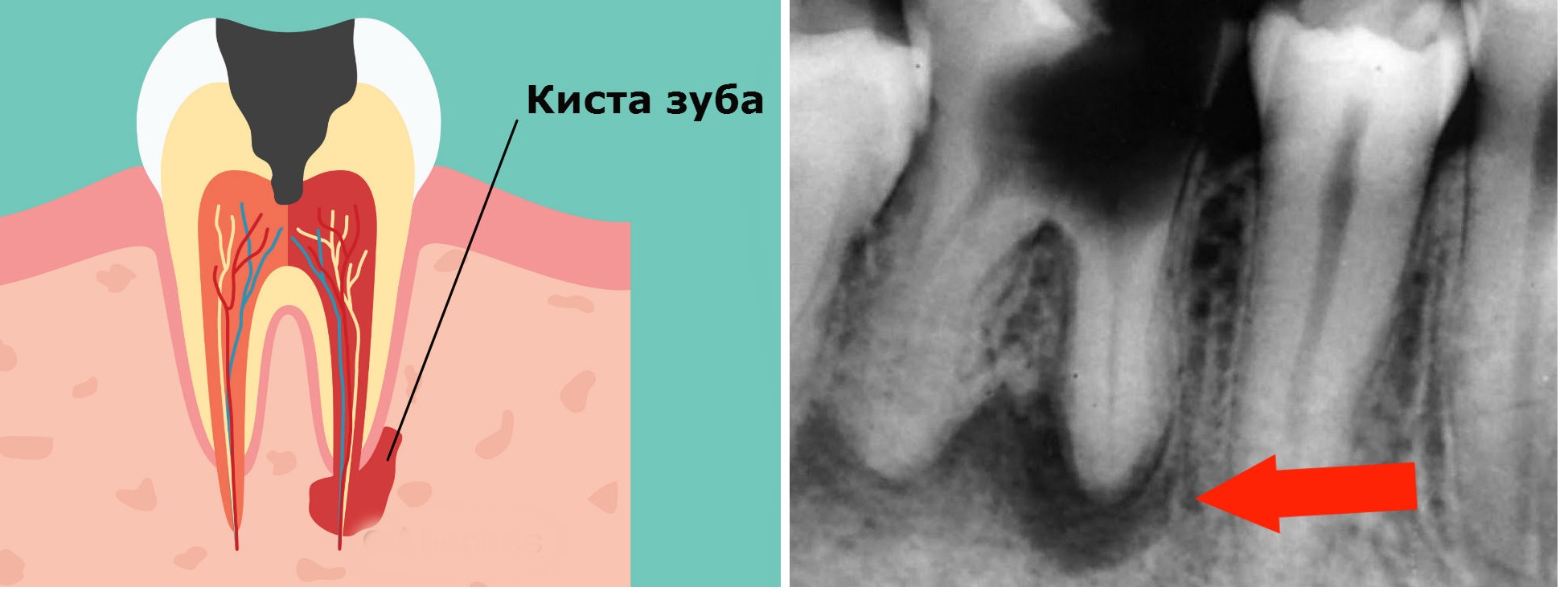 Опасна ли киста зуба