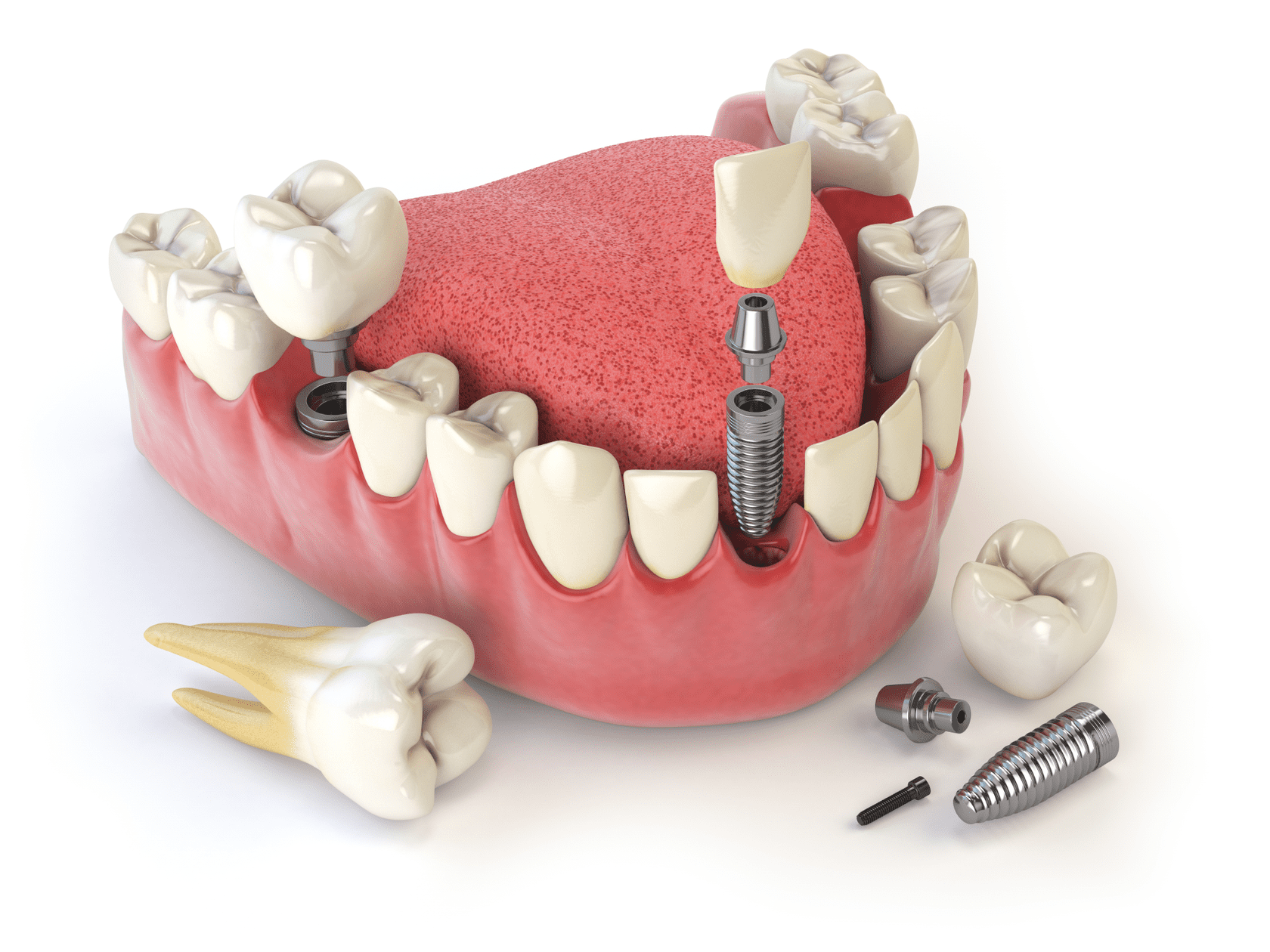 Имплантация зубов «под ключ»